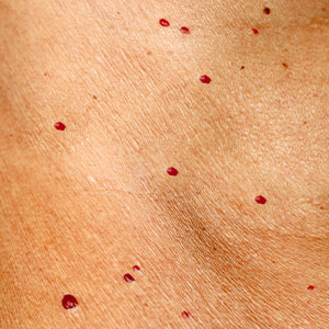 Skinlastiq Medical Laser Cosmetic Spa treats cherry angiomas