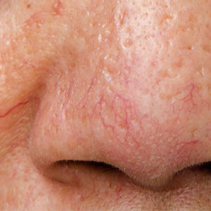 Skinlastiq Medical Laser Cosmetic Spa treats broken capillaries