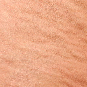 Skinlastiq Medical Laser Cosmetic Spa treats cellulite