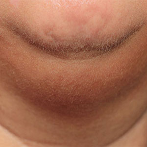 Skinlastiq Medical Laser Cosmetic Spa treats double chin