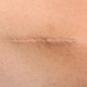 Skinlastiq Medical Laser Cosmetic Spa treats scars and scarring
