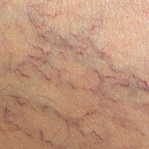 Skinlastiq Medical Laser Cosmetic Spa treats spider veins