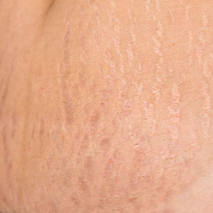 Skinlastiq Medical Laser Cosmetic Spa treats stretch marks