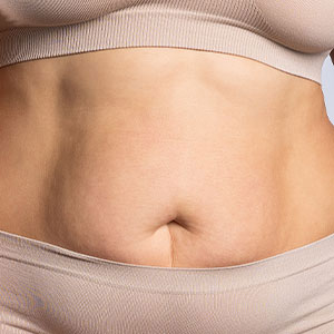 Skinlastiq Medical Laser Cosmetic Spa treats stubborn fat