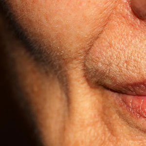 Skinlastiq Medical Laser Cosmetic Spa treats sunken cheeks