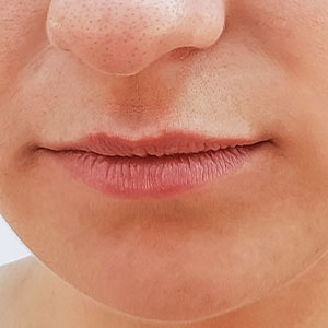Skinlastiq Medical Laser Cosmetic Spa treats thin lips
