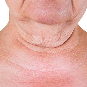 Skinlastiq Medical Laser Cosmetic Spa treats turkey neck