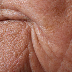 Skinlastiq Medical Laser Cosmetic Spa treats wrinkles