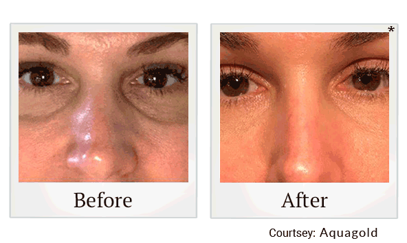 Aquagold results for dark eye circles at Skinlastiq Medical Laser Cosmetic Spa in Burlingame