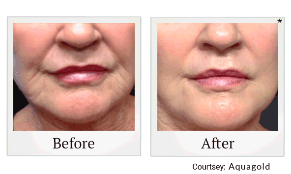 Aquagold results for wrinkles and fine lines at Skinlastiq Medical Laser Cosmetic Spa in Burlingame
