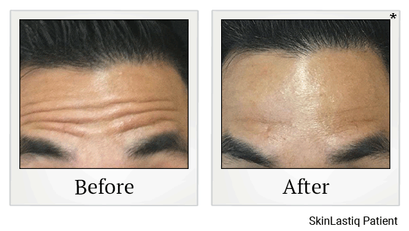 botox before and after at Skinlastiq Medical Laser Cosmetic Spa in Burlingame