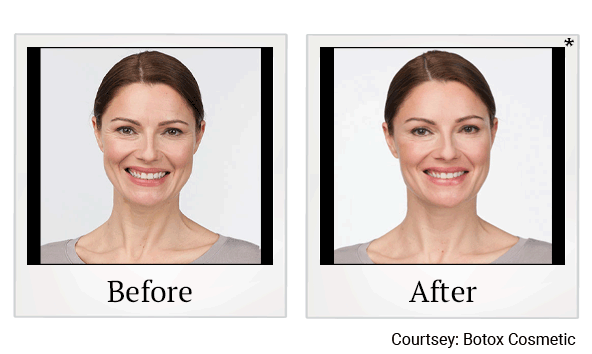 botox before and after at Skinlastiq Medical Laser Cosmetic Spa in Burlingame