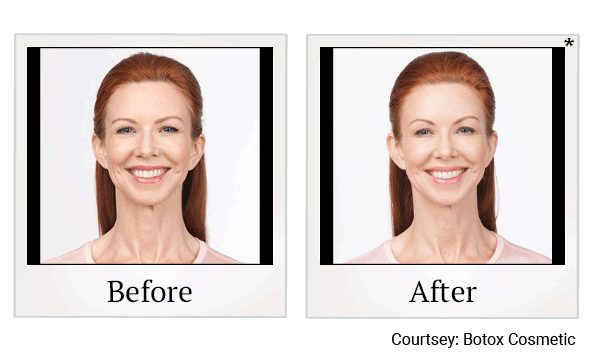 Botox results for frown lines at Skinlastiq Medical Laser Cosmetic Spa in Burlingame