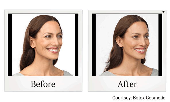botox before and after at Skinlastiq Medical Laser Cosmetic Spa in Burlingame
