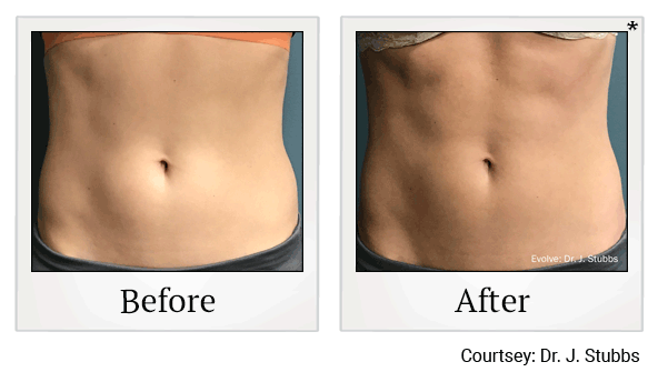 evolve tone before and after at Skinlastiq Medical Laser Cosmetic Spa in Burlingame