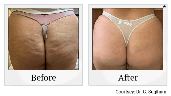 Evolve Tone Muscle Toning before and after at Skinlastiq Medical Laser Cosmetic Spa in Burlingame