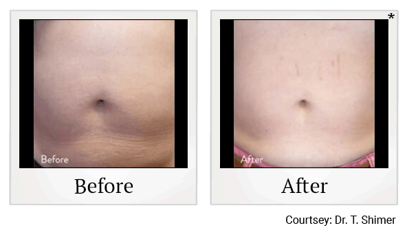 evolve tone before and after at Skinlastiq Medical Laser Cosmetic Spa in Burlingame