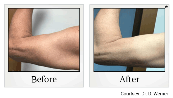 Evolve Tone Muscle Toning before and after at Skinlastiq Medical Laser Cosmetic Spa in Burlingame