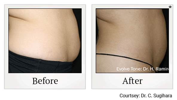 Evolve Tone Muscle Toning before and after at Skinlastiq Medical Laser Cosmetic Spa in Burlingame