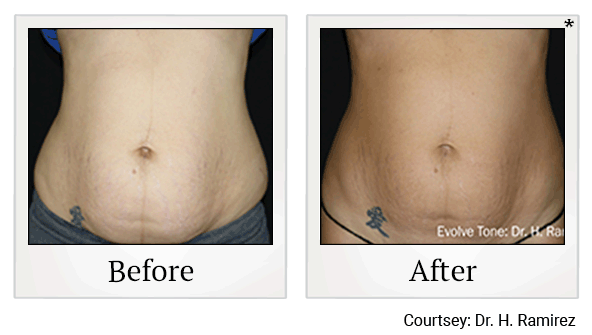 Evolve Tone Muscle Toning before and after at Skinlastiq Medical Laser Cosmetic Spa in Burlingame