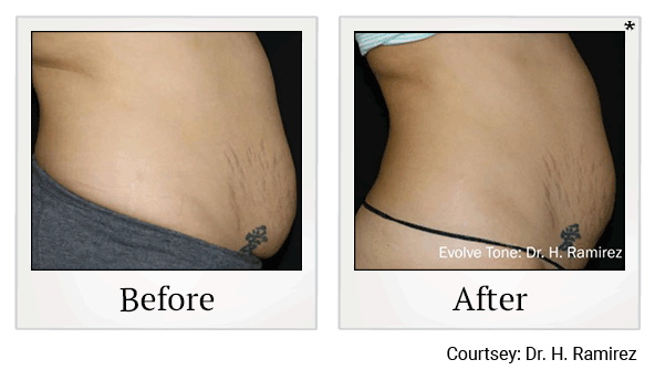 Evolve Tone Muscle Toning before and after at Skinlastiq Medical Laser Cosmetic Spa in Burlingame