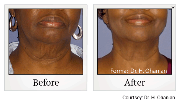 forma before and after at Skinlastiq Medical Laser Cosmetic Spa in Burlingame