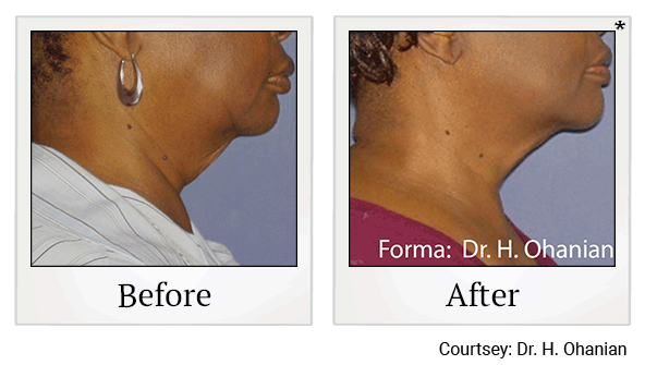 forma before and after at Skinlastiq Medical Laser Cosmetic Spa in Burlingame