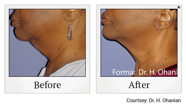 forma before and after at Skinlastiq Medical Laser Cosmetic Spa in Burlingame