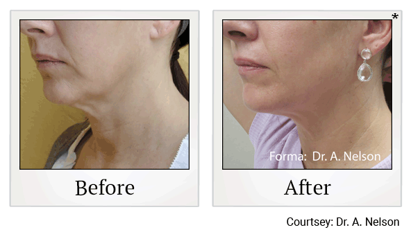 forma before and after at Skinlastiq Medical Laser Cosmetic Spa in Burlingame