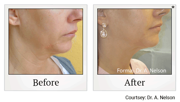 forma before and after at Skinlastiq Medical Laser Cosmetic Spa in Burlingame