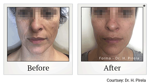 forma before and after at Skinlastiq Medical Laser Cosmetic Spa in Burlingame