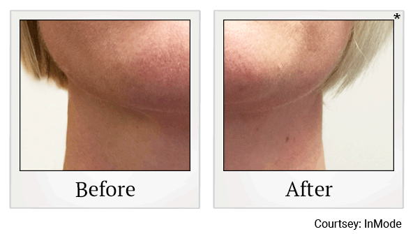 forma before and after at Skinlastiq Medical Laser Cosmetic Spa in Burlingame