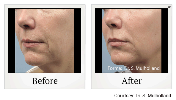 forma before and after at Skinlastiq Medical Laser Cosmetic Spa in Burlingame