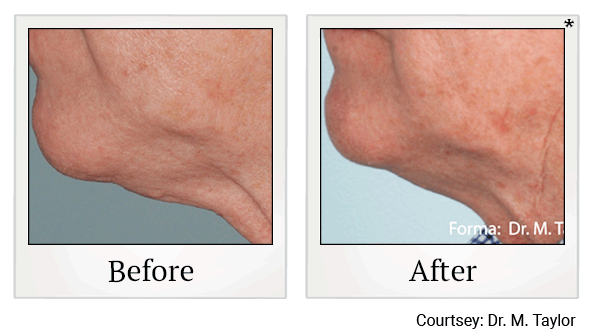 forma before and after at Skinlastiq Medical Laser Cosmetic Spa in Burlingame