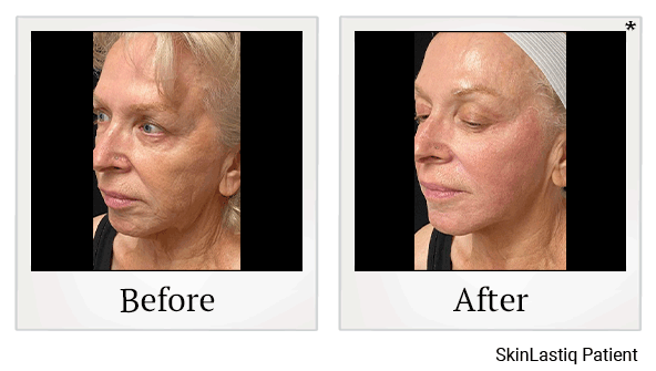 Forma Skin Tightening results for jowls at Skinlastiq Medical Laser Cosmetic Spa in Burlingame
