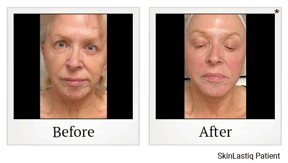 forma before and after at Skinlastiq Medical Laser Cosmetic Spa in Burlingame