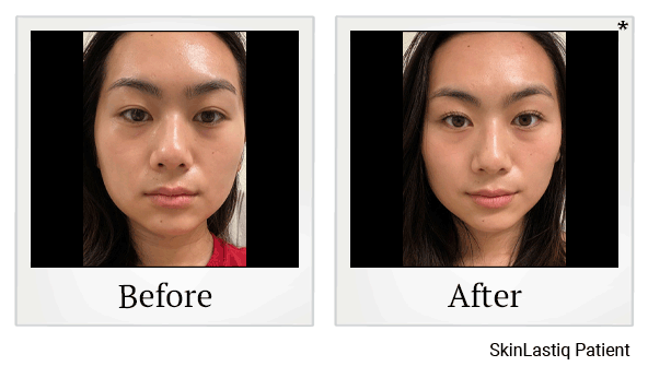 forma before and after at Skinlastiq Medical Laser Cosmetic Spa in Burlingame