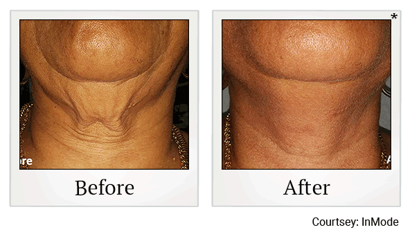 forma before and after at Skinlastiq Medical Laser Cosmetic Spa in Burlingame