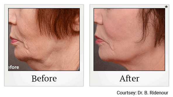 forma before and after at Skinlastiq Medical Laser Cosmetic Spa in Burlingame