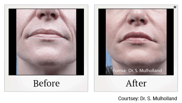 forma before and after at Skinlastiq Medical Laser Cosmetic Spa in Burlingame