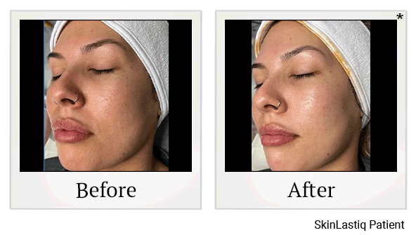 glo2facial before and after at Skinlastiq Medical Laser Cosmetic Spa in Burlingame