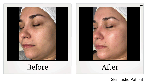 glo2facial before and after at Skinlastiq Medical Laser Cosmetic Spa in Burlingame