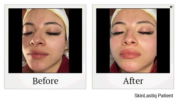 glo2facial before and after at Skinlastiq Medical Laser Cosmetic Spa in Burlingame