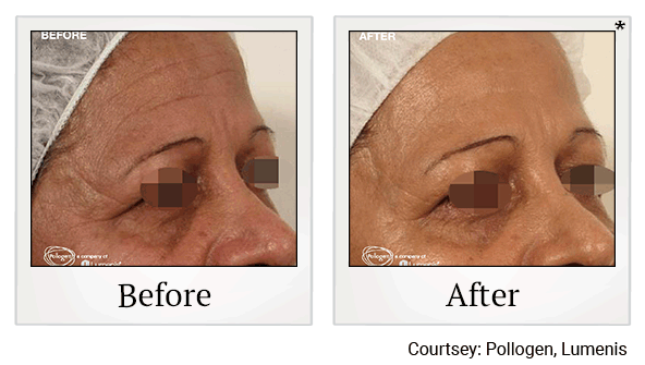 Glo2Facials results for anti-aging at Skinlastiq Medical Laser Cosmetic Spa in Burlingame
