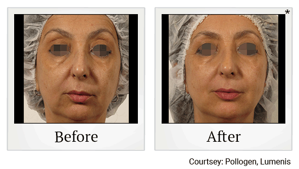 glo2facial before and after at Skinlastiq Medical Laser Cosmetic Spa in Burlingame