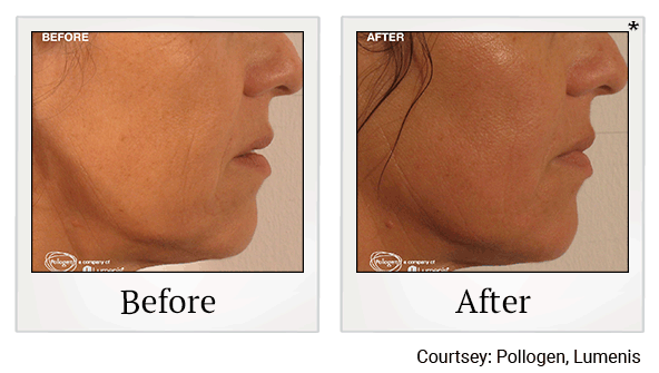 Glo2Facials results for fine lines at Skinlastiq Medical Laser Cosmetic Spa in Burlingame