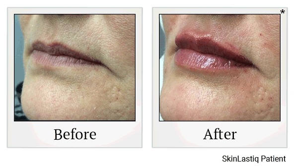 Juvederm results for wrinkles at Skinlastiq Medical Laser Cosmetic Spa in Burlingame