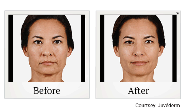 juvederm ultra before and after at Skinlastiq Medical Laser Cosmetic Spa in Burlingame