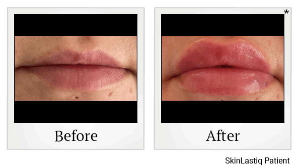 Juvederm results for thin lips at Skinlastiq Medical Laser Cosmetic Spa in Burlingame