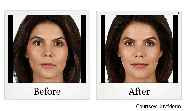 juvederm volbella before and after at Skinlastiq Medical Laser Cosmetic Spa in Burlingame